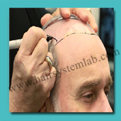 Non Surgical Hair Replacement